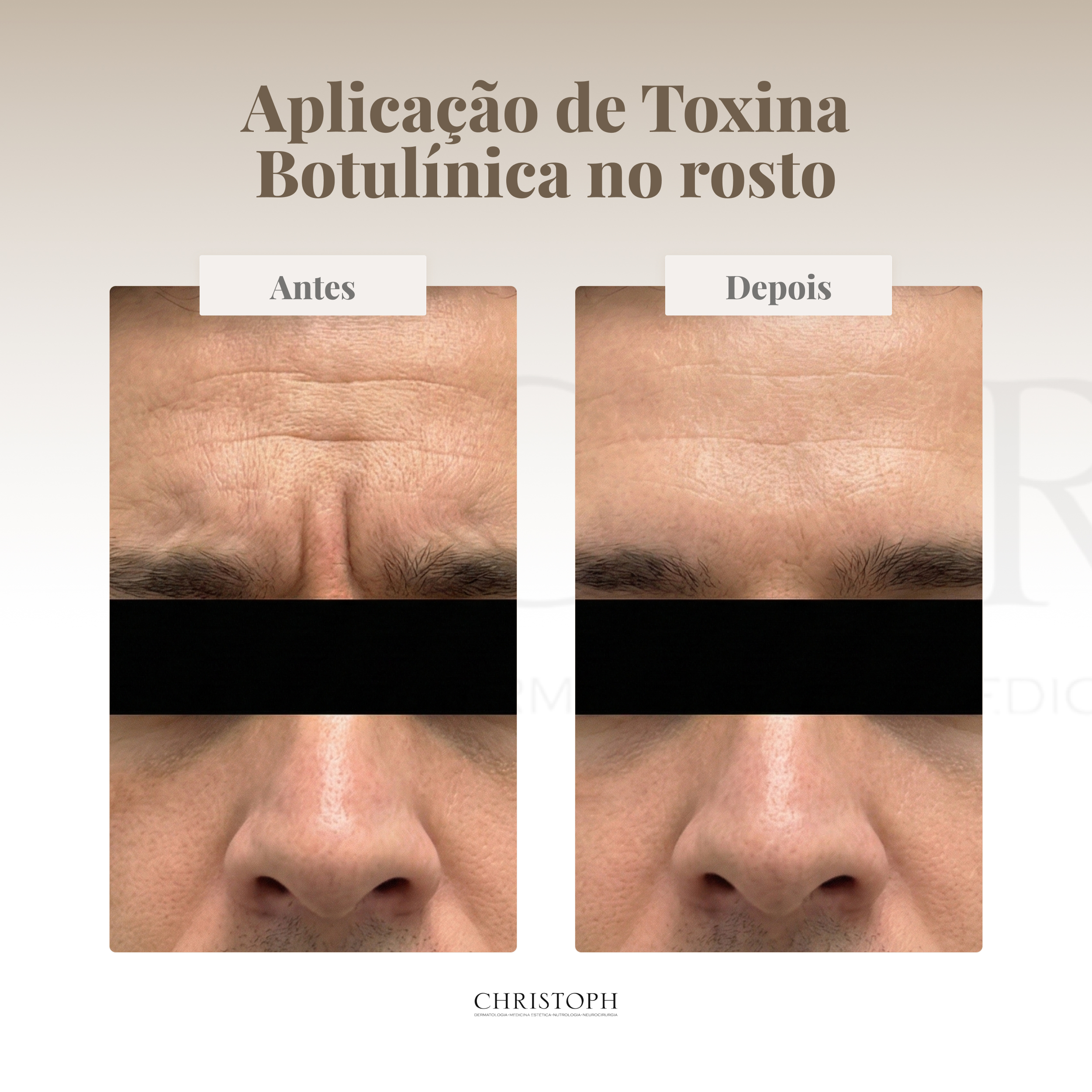 Aplicação de Toxina Botulínica no rosto