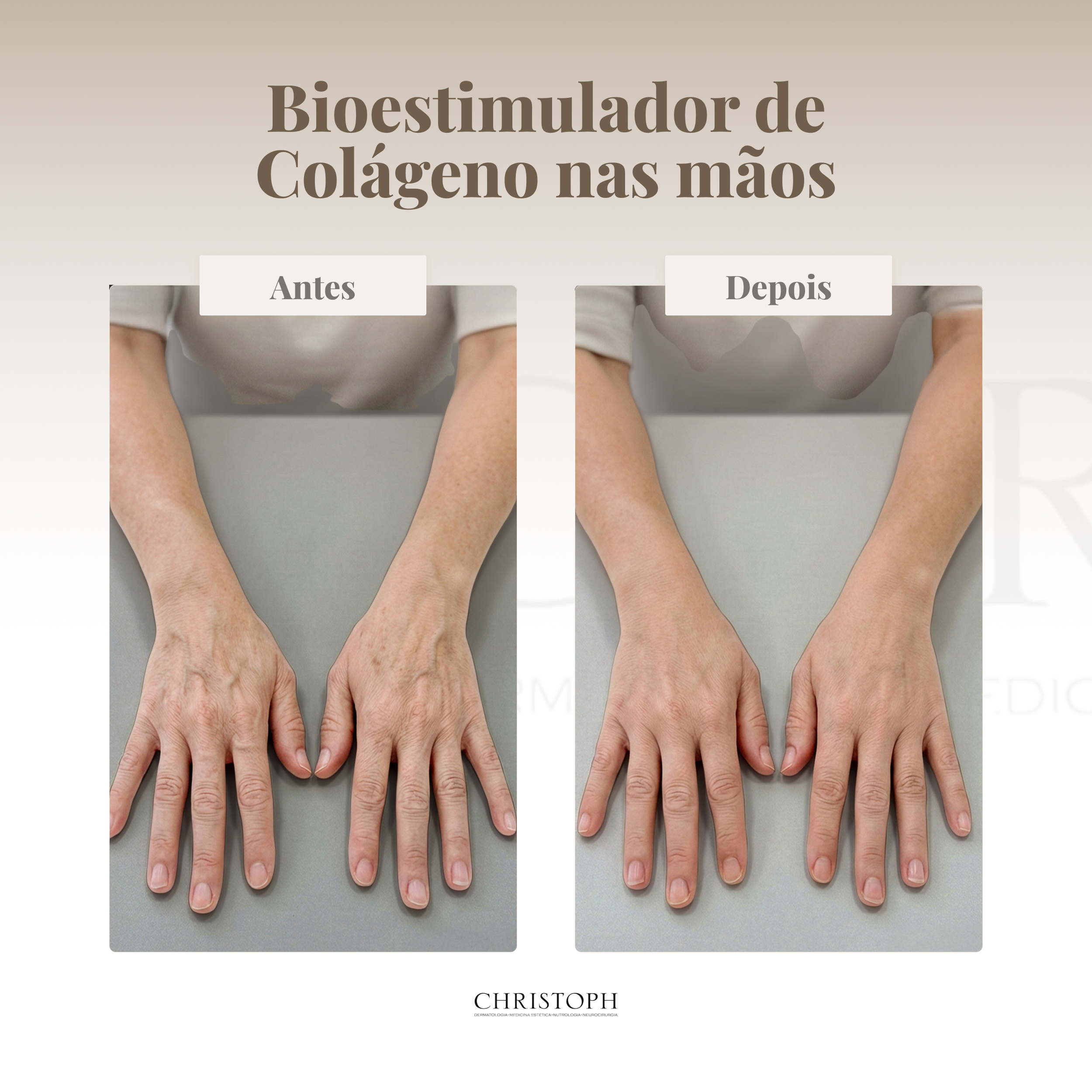 Bioestimulador de Colágeno nas mãos