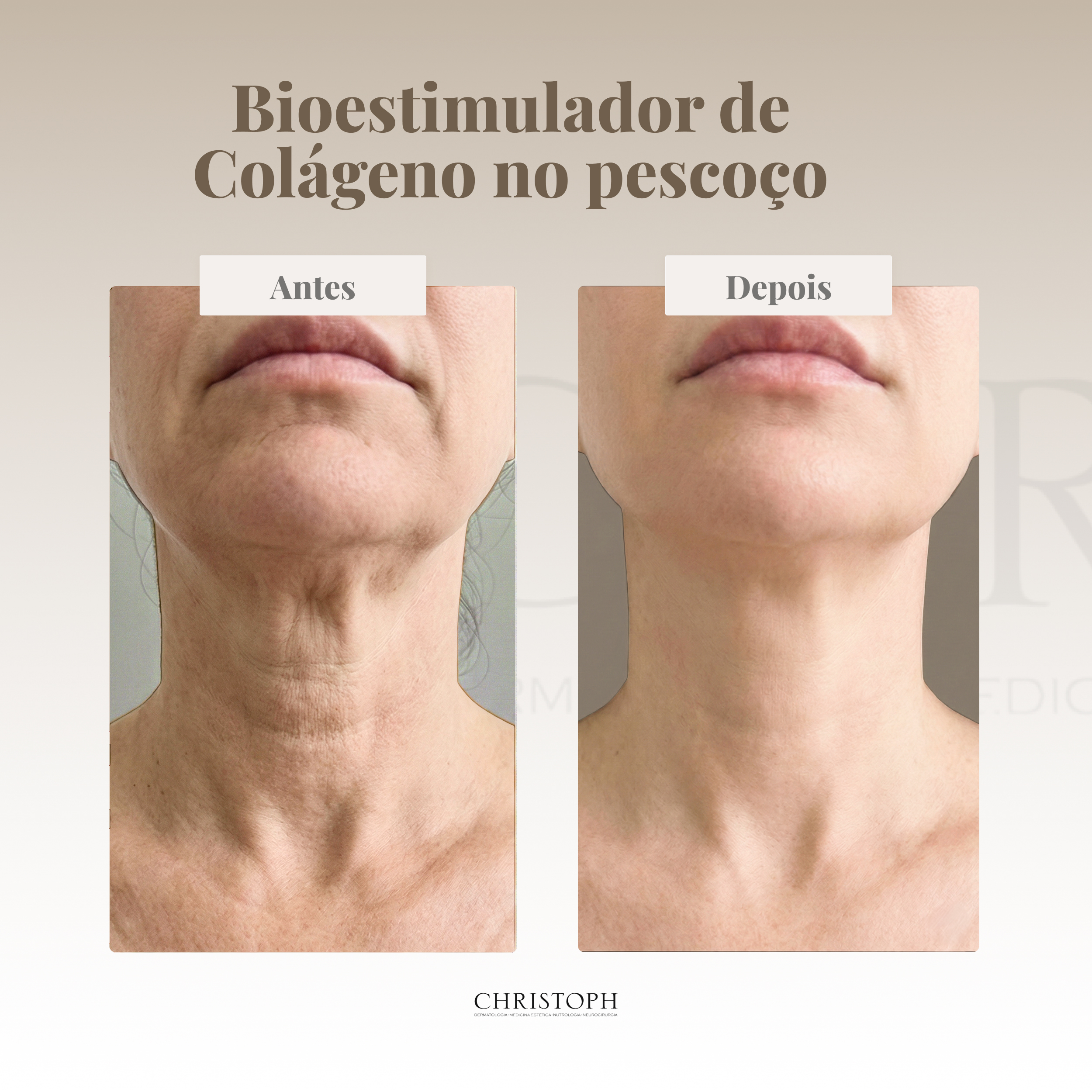 Bioestimulador de Colágeno no pescoço