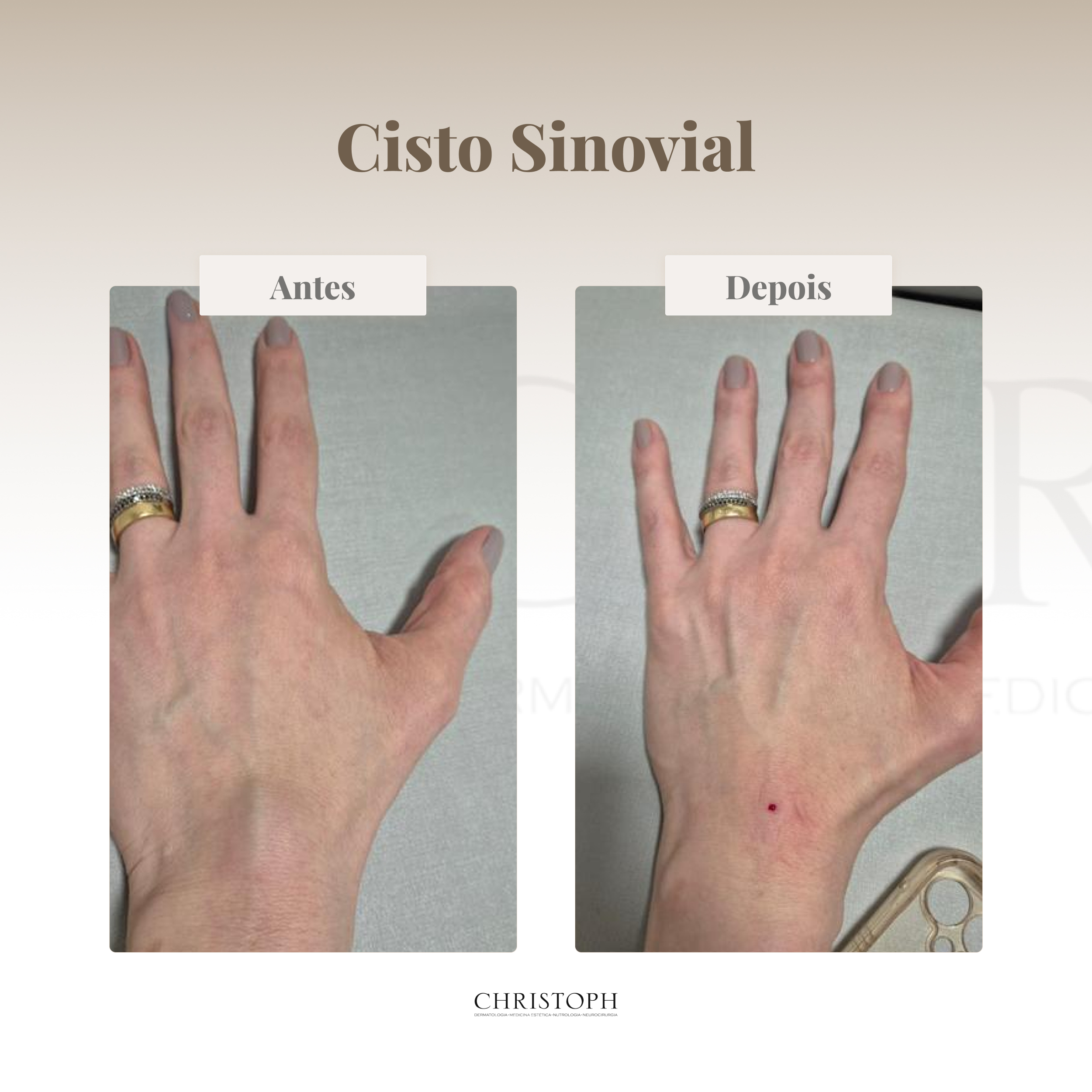 Cisto Sinovial