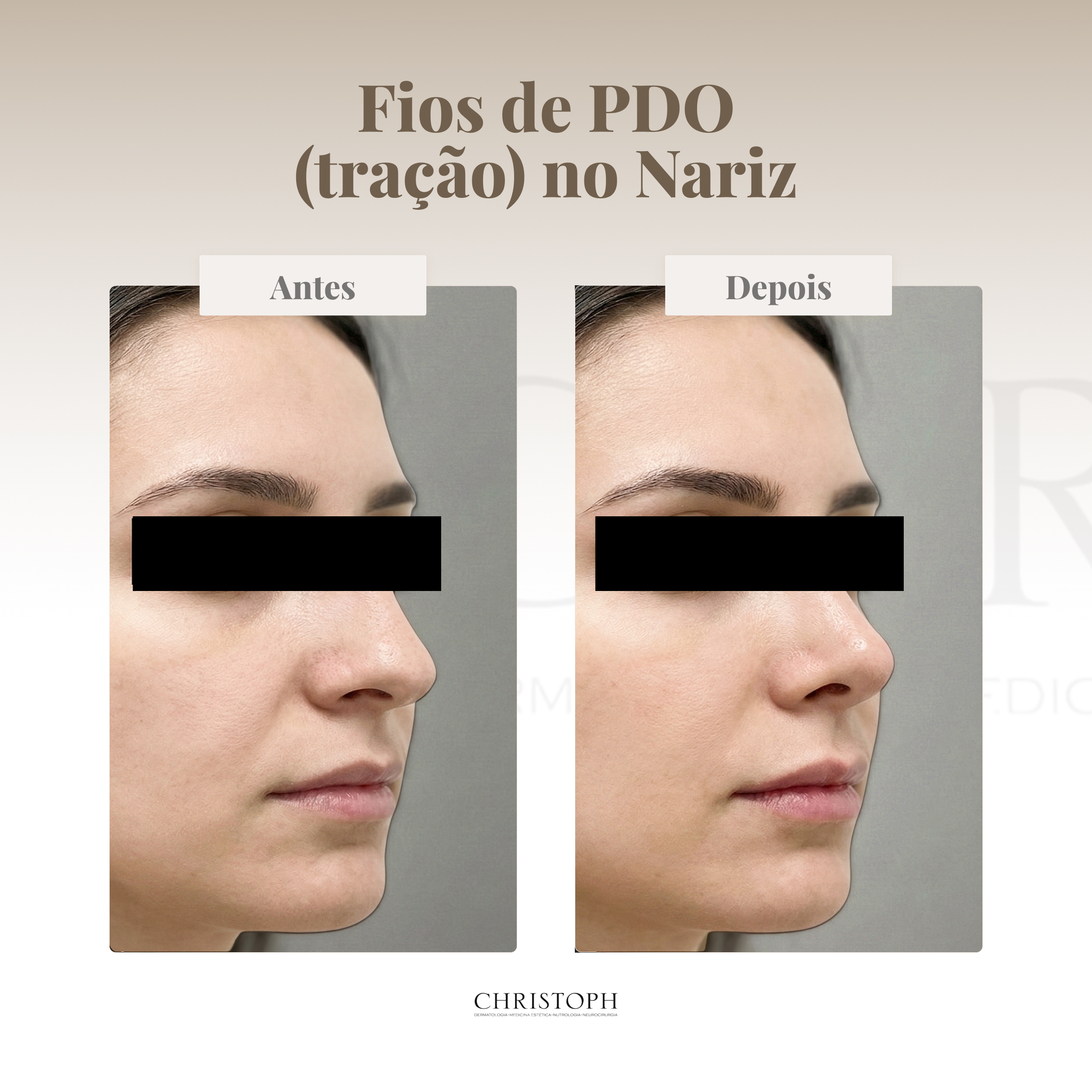 Fios de PDO (tração) no Nariz