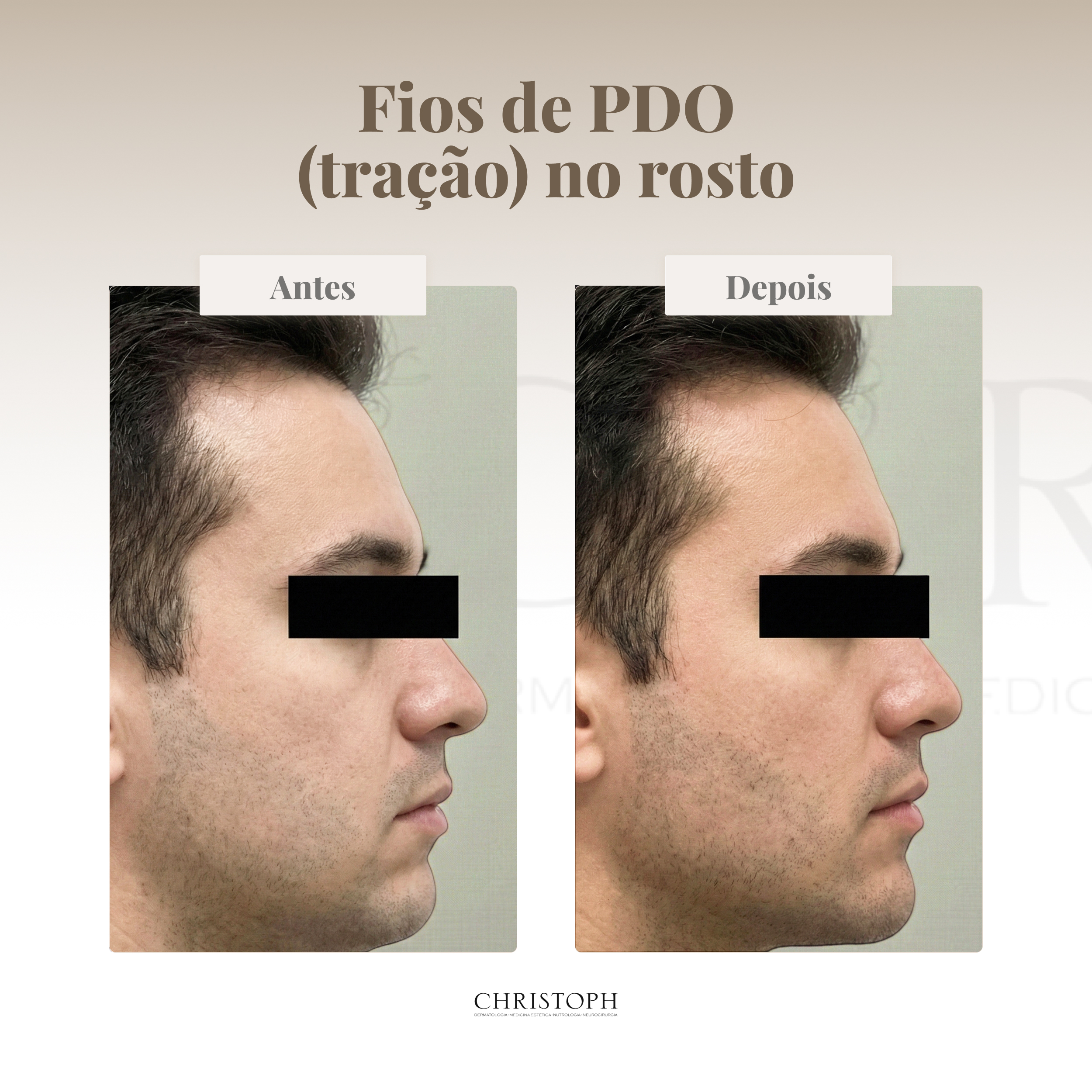 Fios de PDO (tração) no rosto