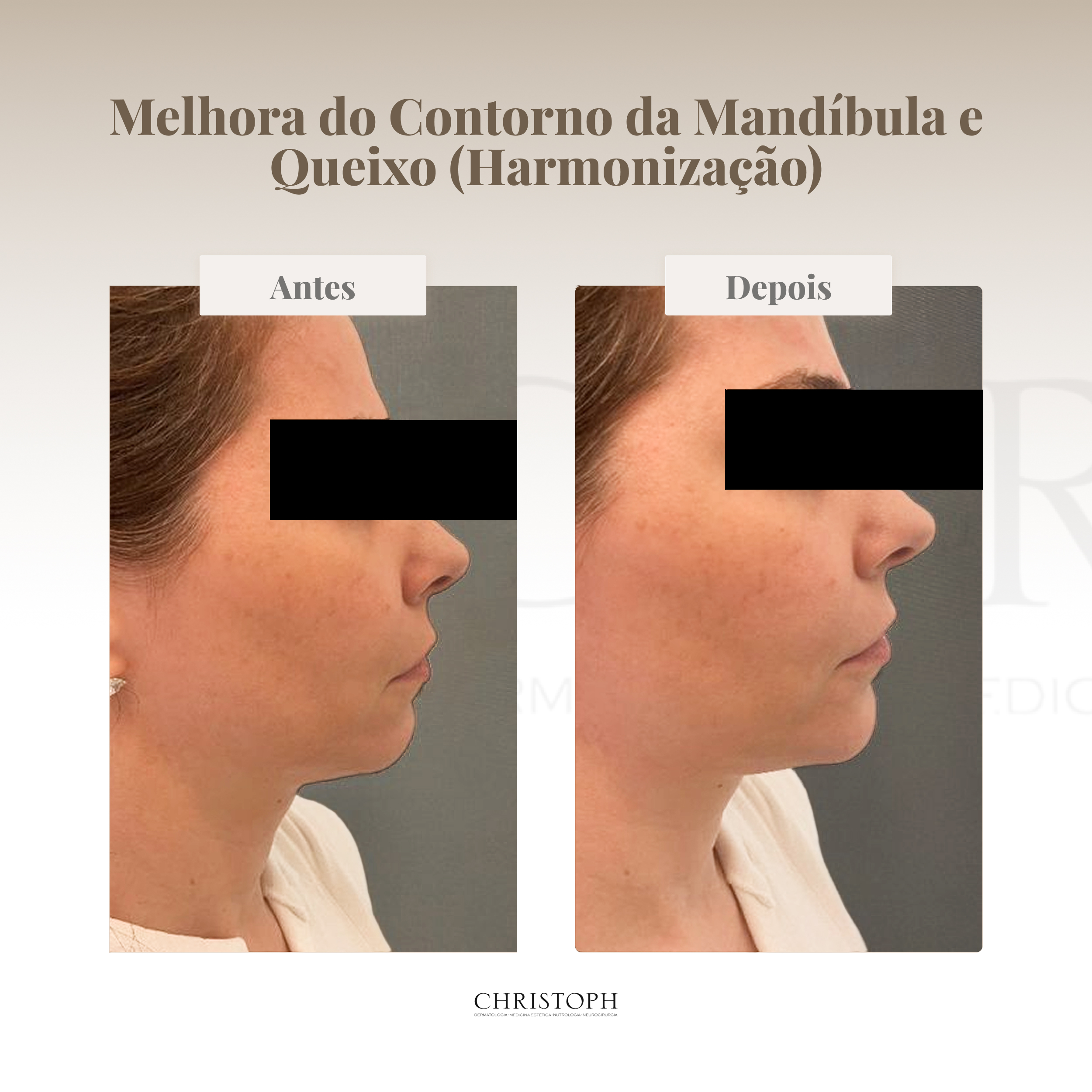 Melhora do contorno da mandíbula e queixo (harmonização)