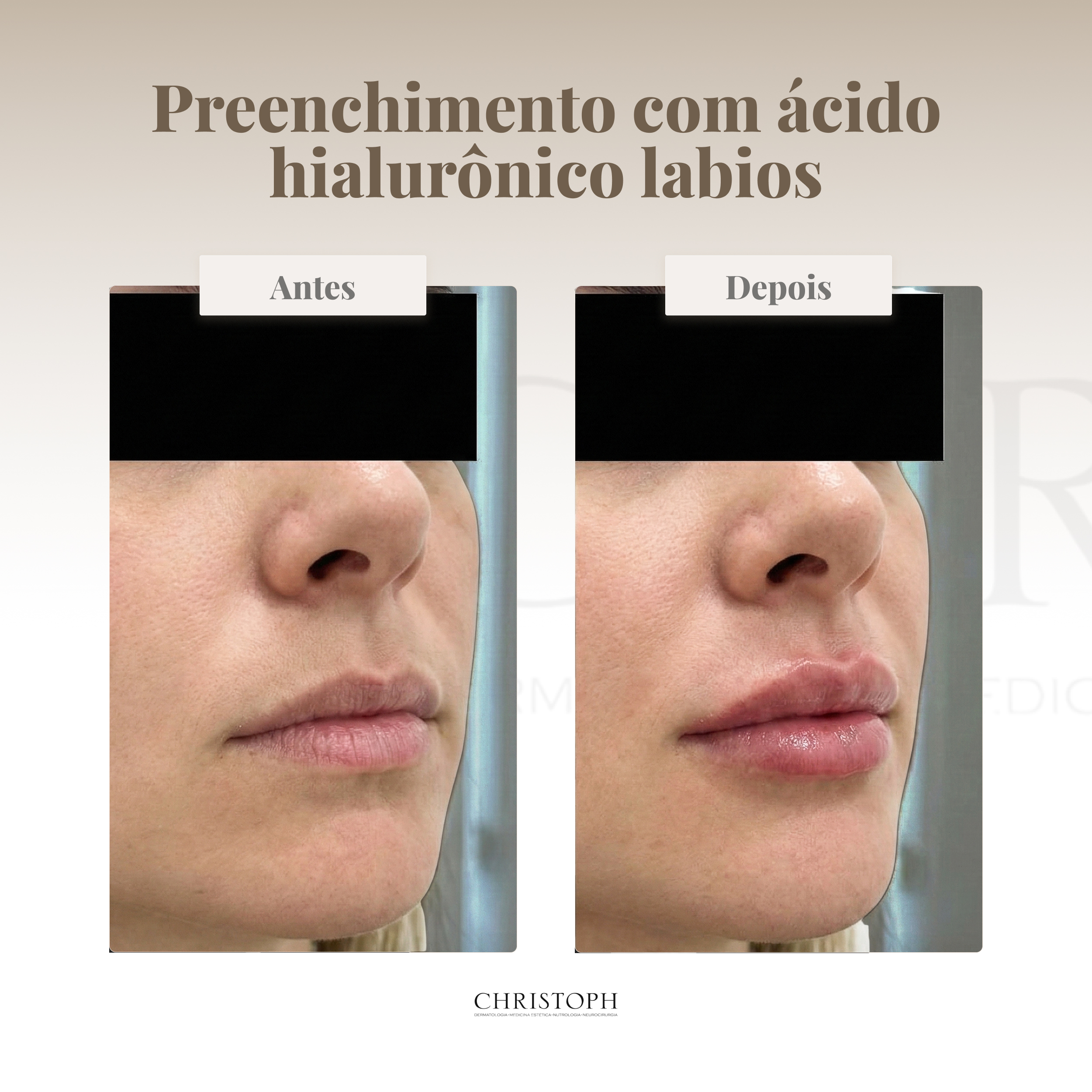 Preenchimento com ácido hialurônico labios