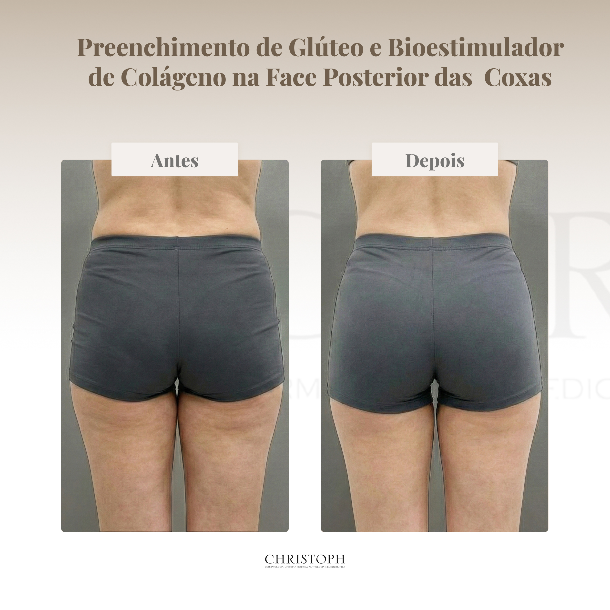 Preenchimento de glúteo e bioestimulador de colageno