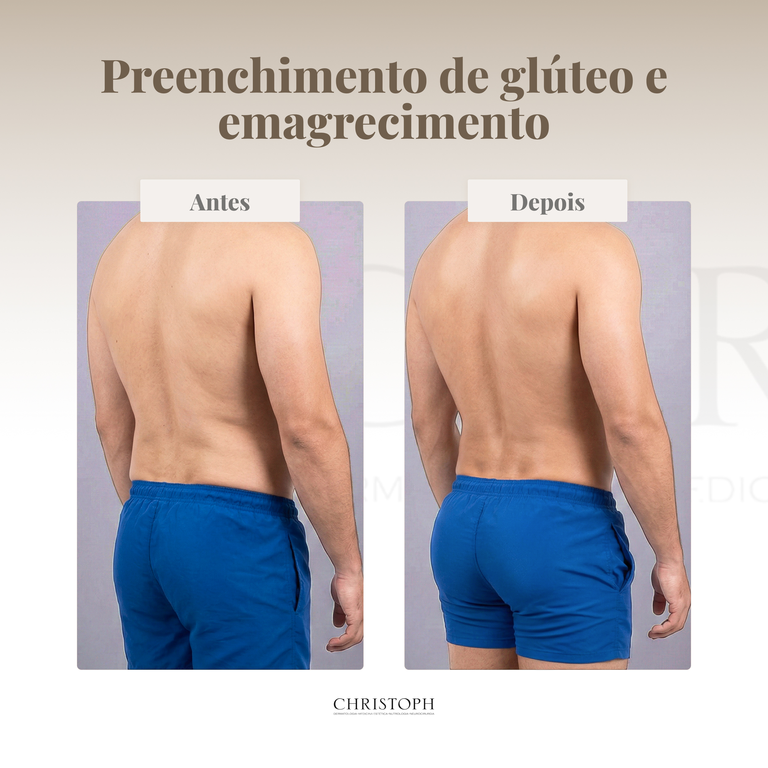 Preenchimento de glúteo e emagrecimento