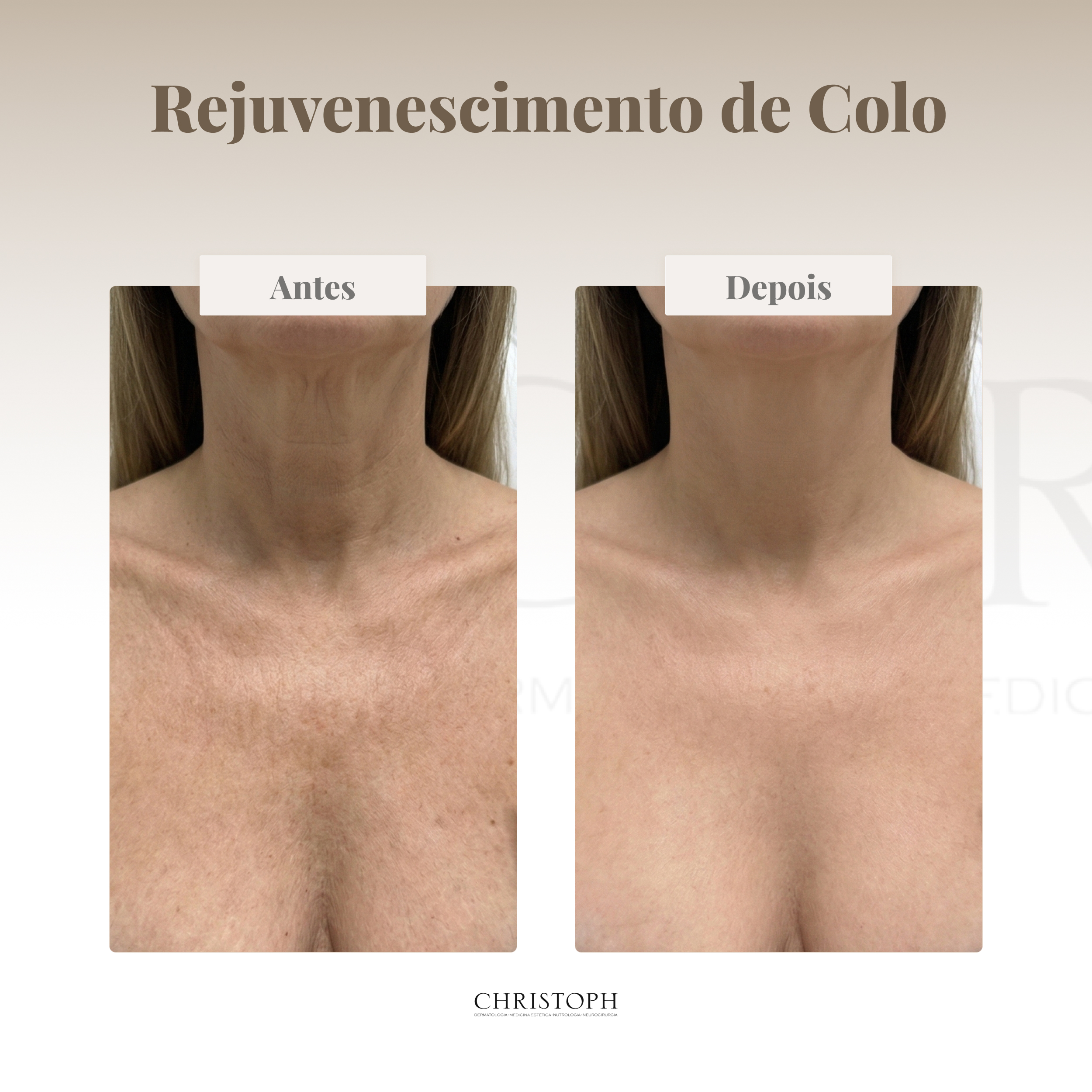 Rejuvenescimento de colo