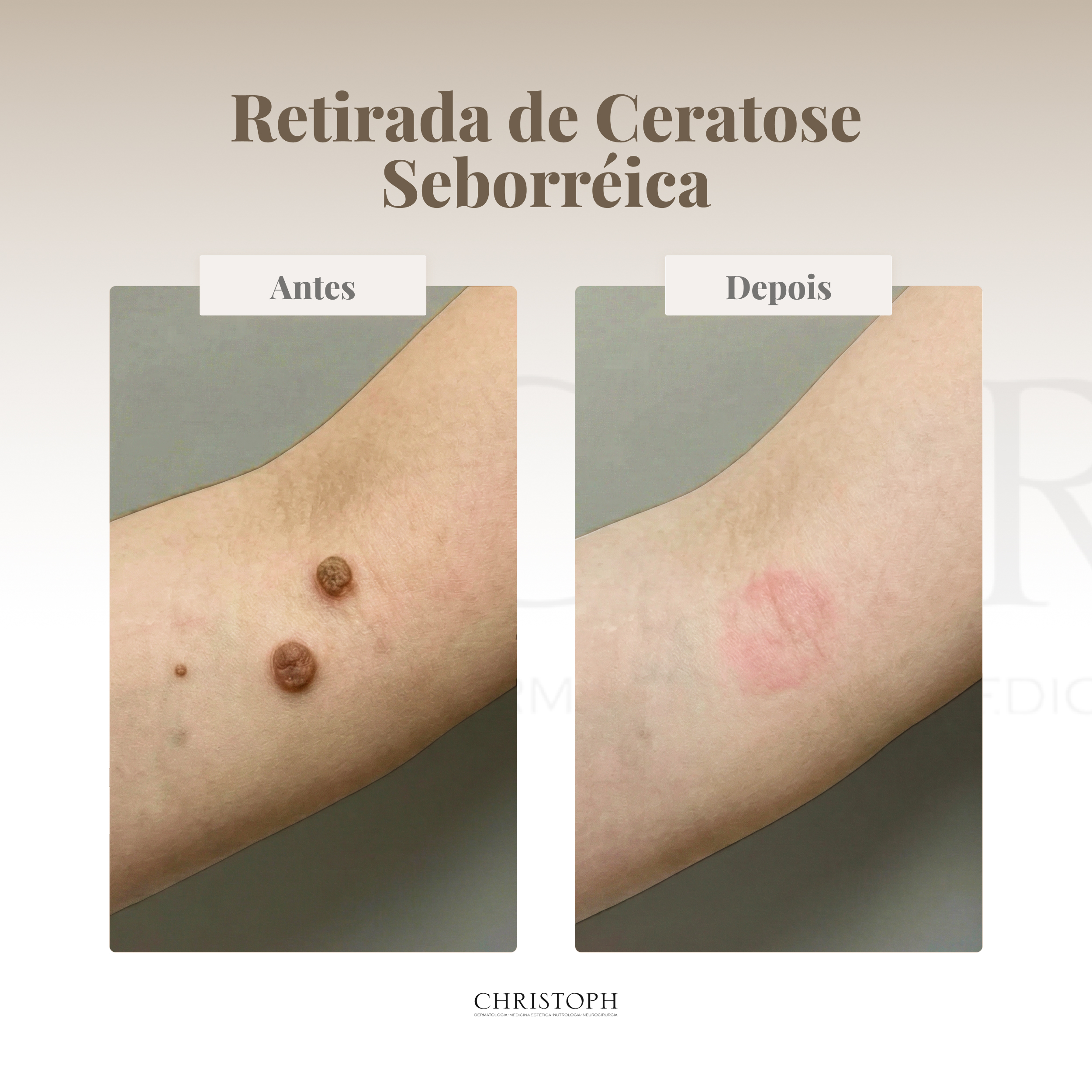 Retirada de Ceratose Seborréica