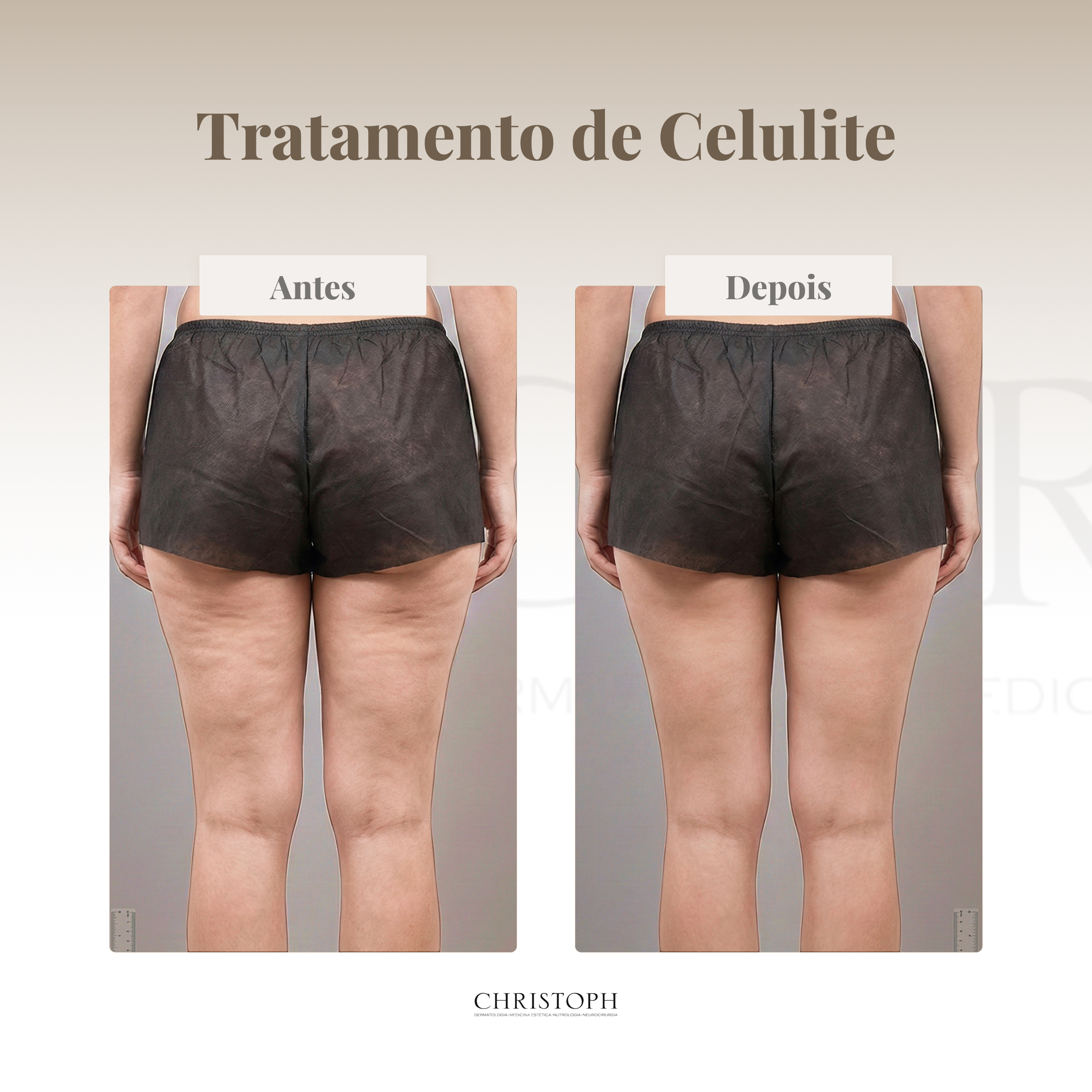Tratamento de Celulite