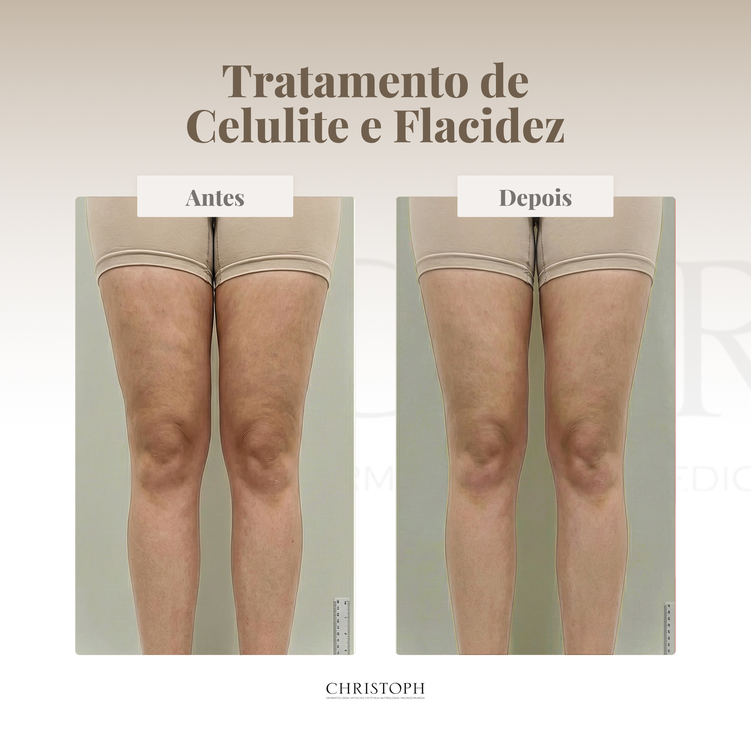 Tratamento de Celulite e Flacidez