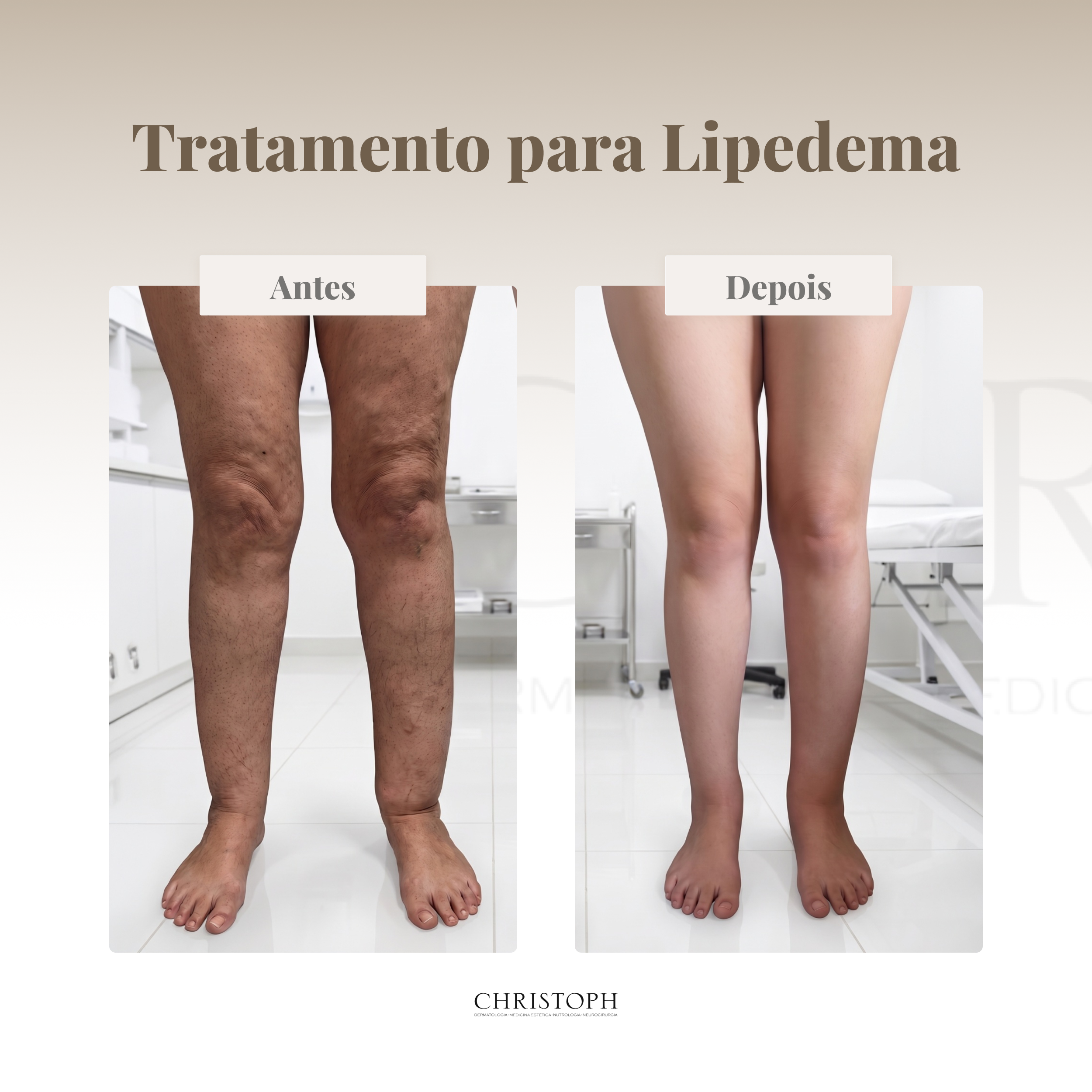 tratamento_para_lipedema
