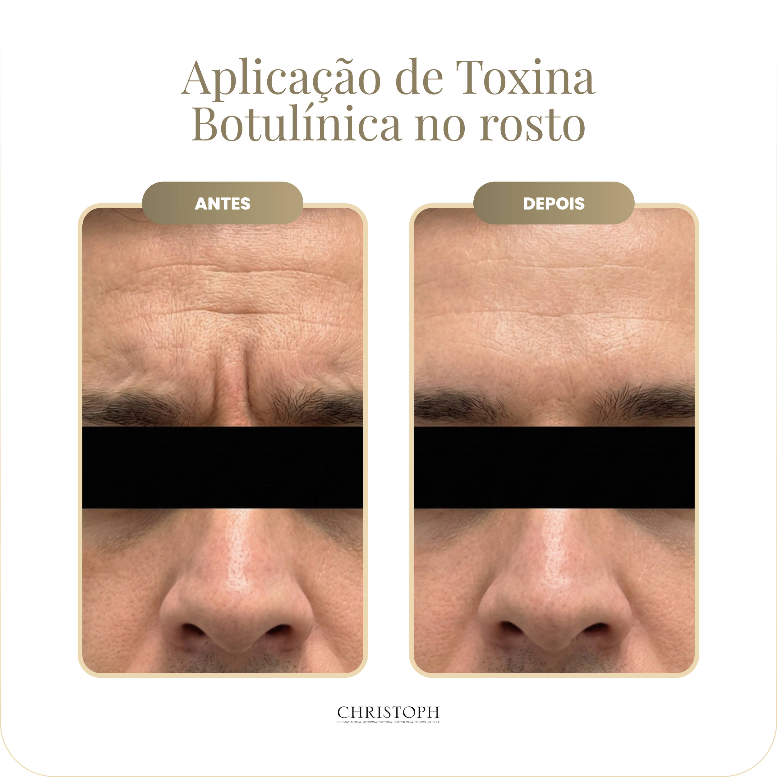 aplica_o_de_toxina_botul_nica_no_rosto-homem