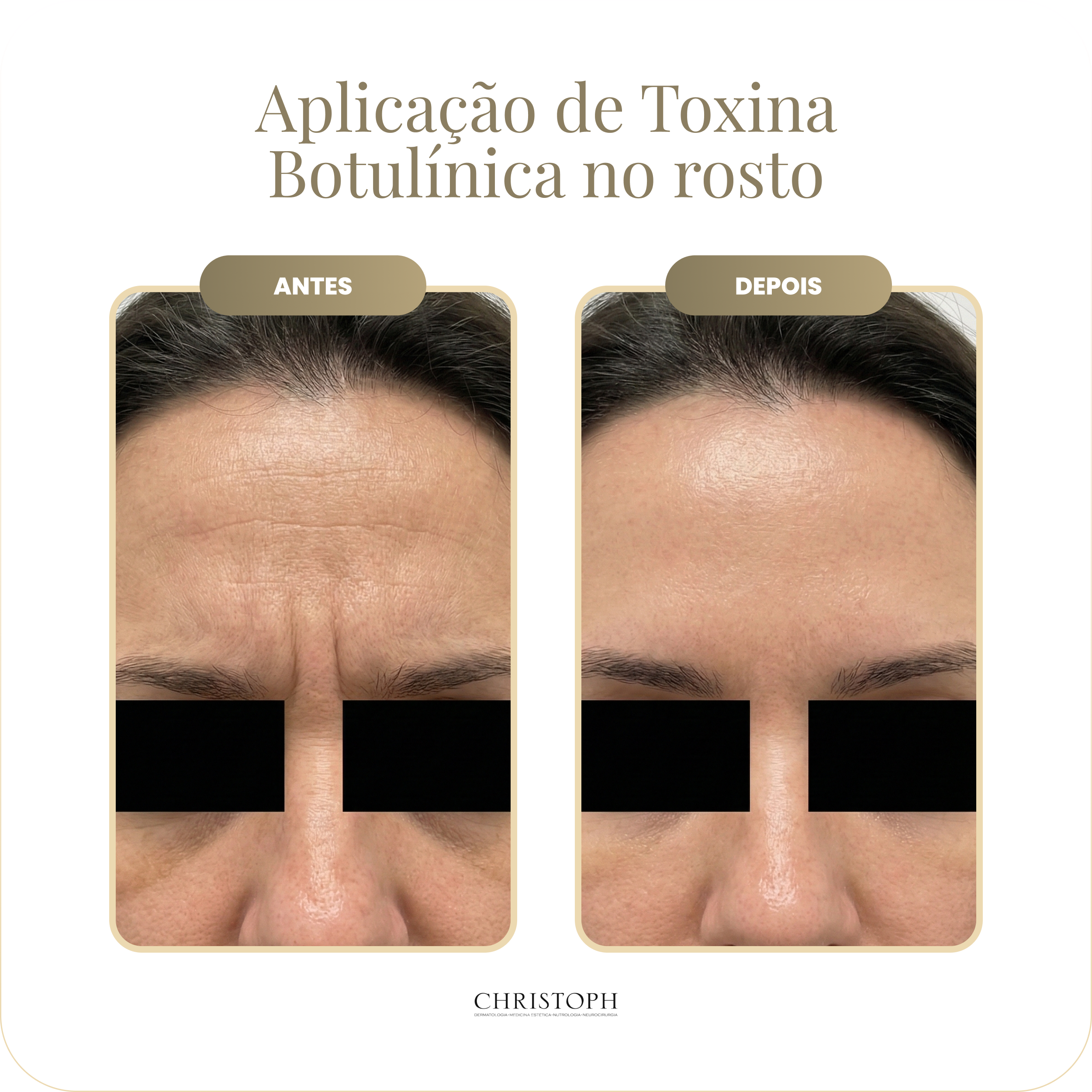 aplica_o_de_toxina_botul_nica_no_rosto