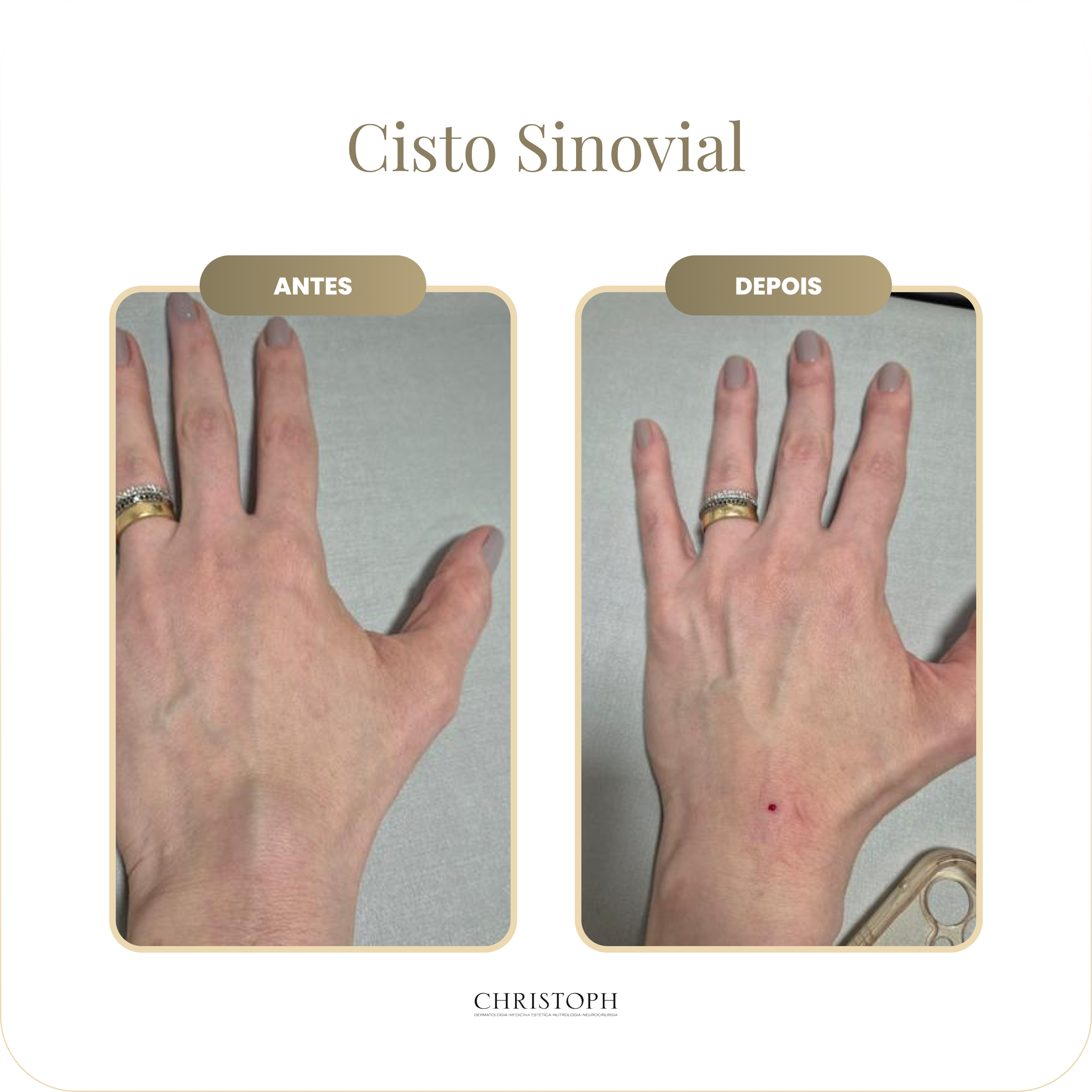 cisto_sinovial