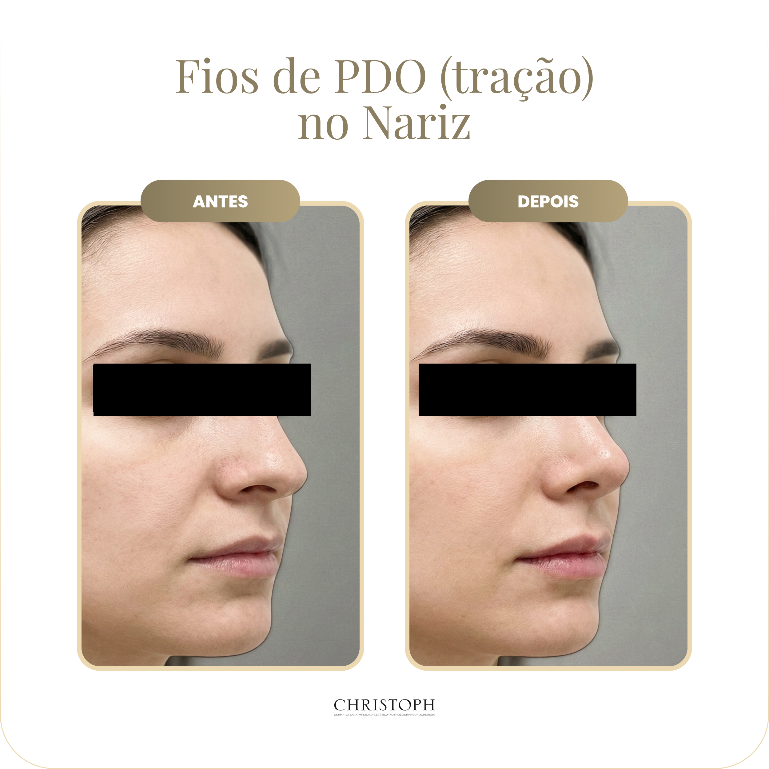 fios_de_pdo_tra_o_no_nariz