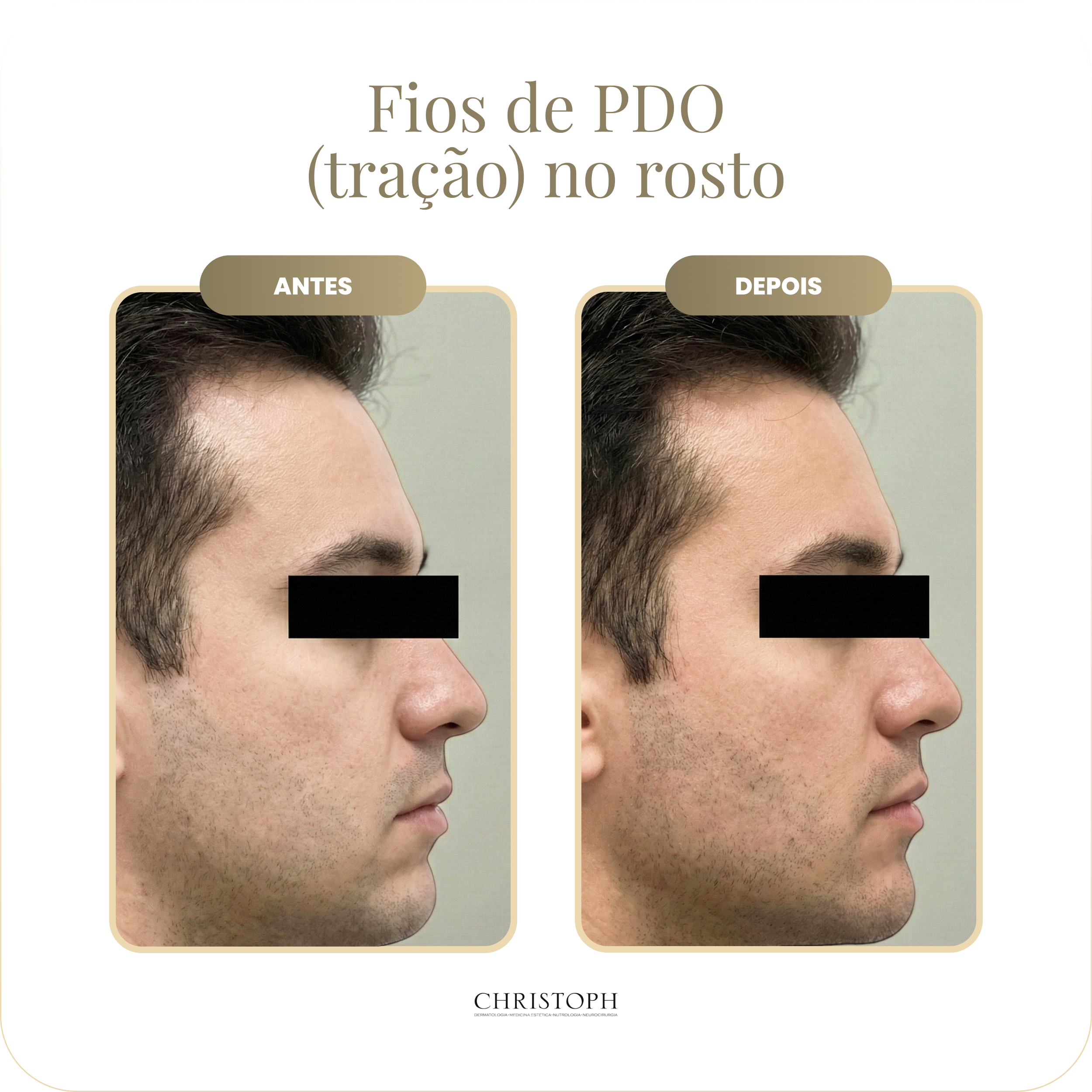 fios_de_pdo_tra_o_no_rosto