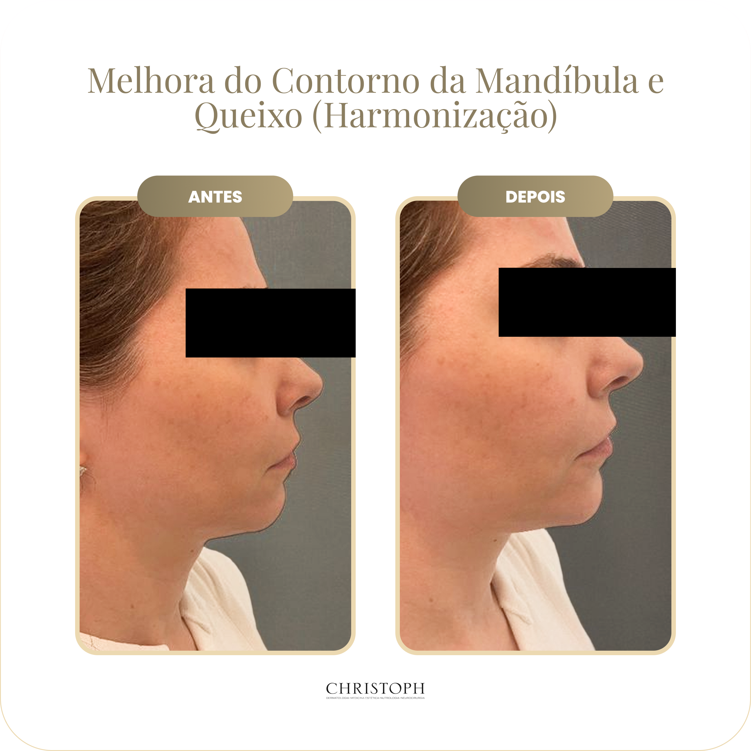 melhora_do_contorno_da_mand_bula_e_queixo_harmoniza_o_