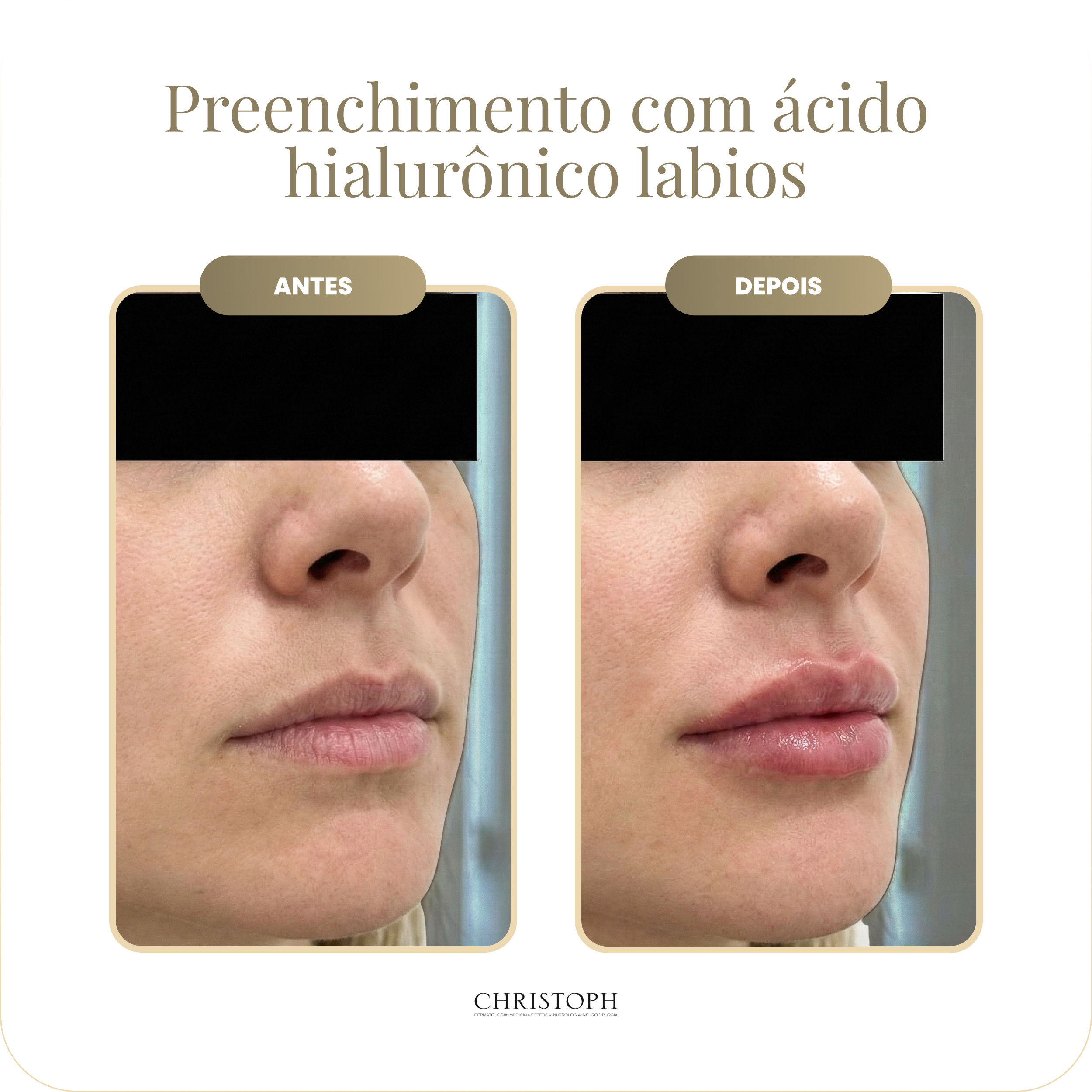 preenchimento_com_cido_hialur_nico_labios