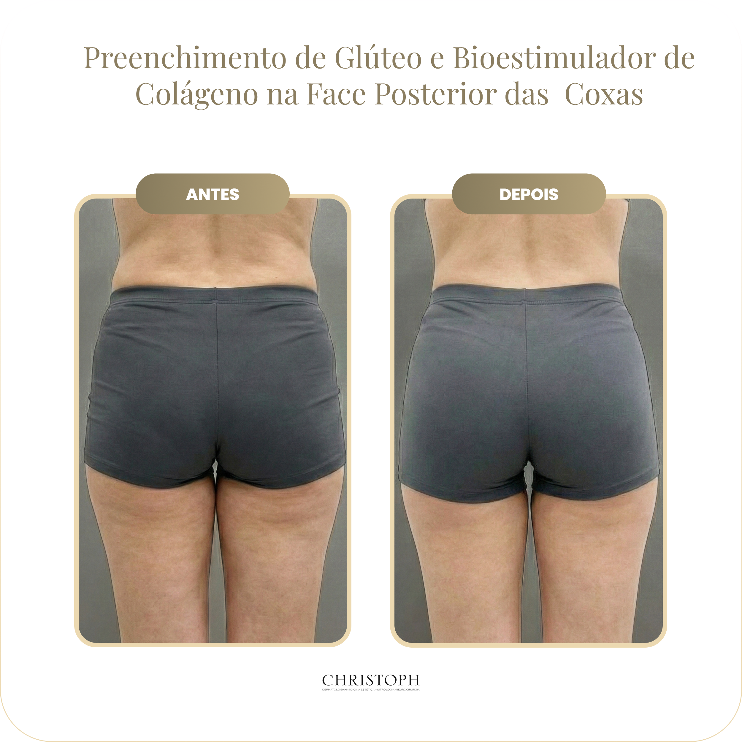 preenchimento_de_gl_teo_e_bioestimulador_de_colageno