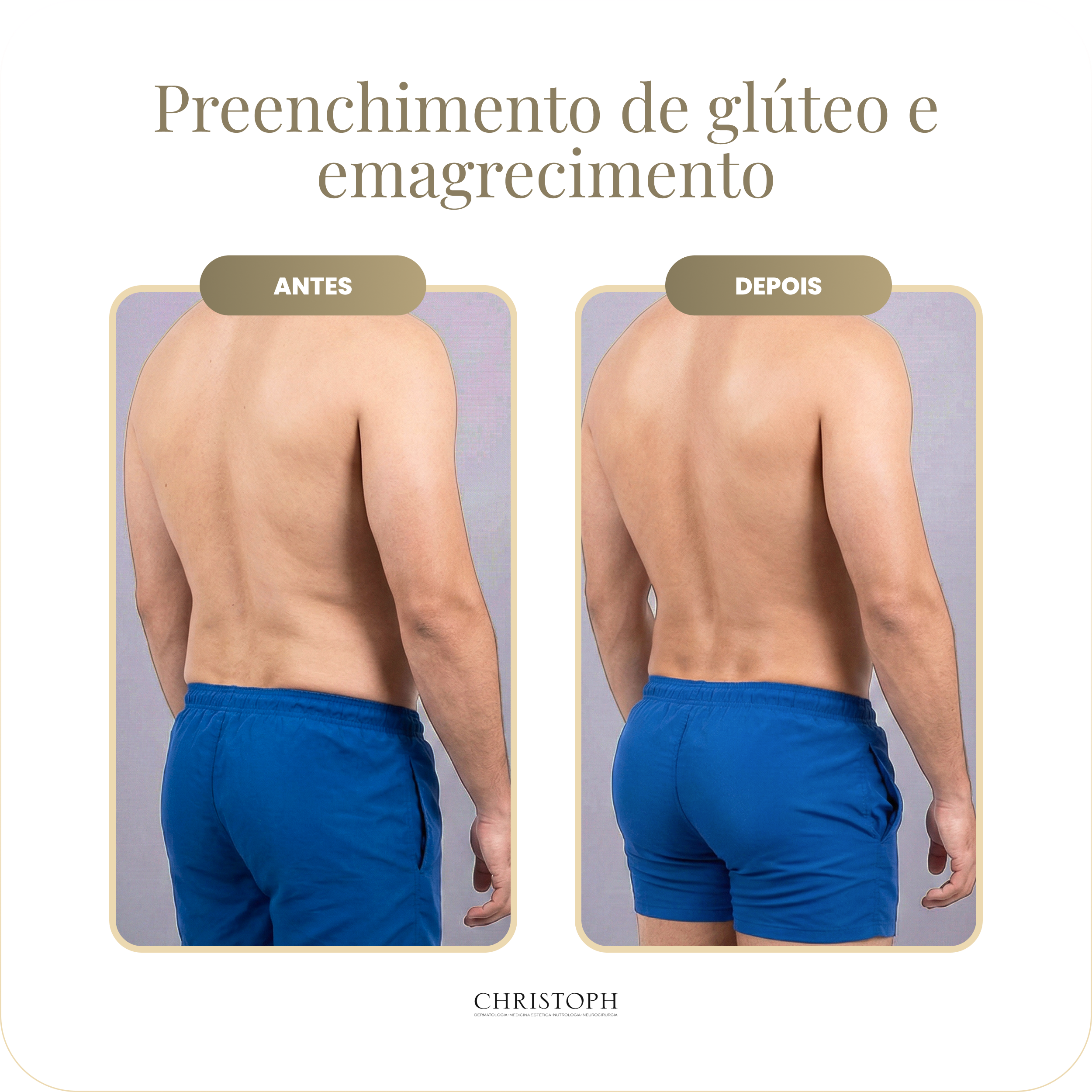 preenchimento_de_gl_teo_e_emagrecimento-homem