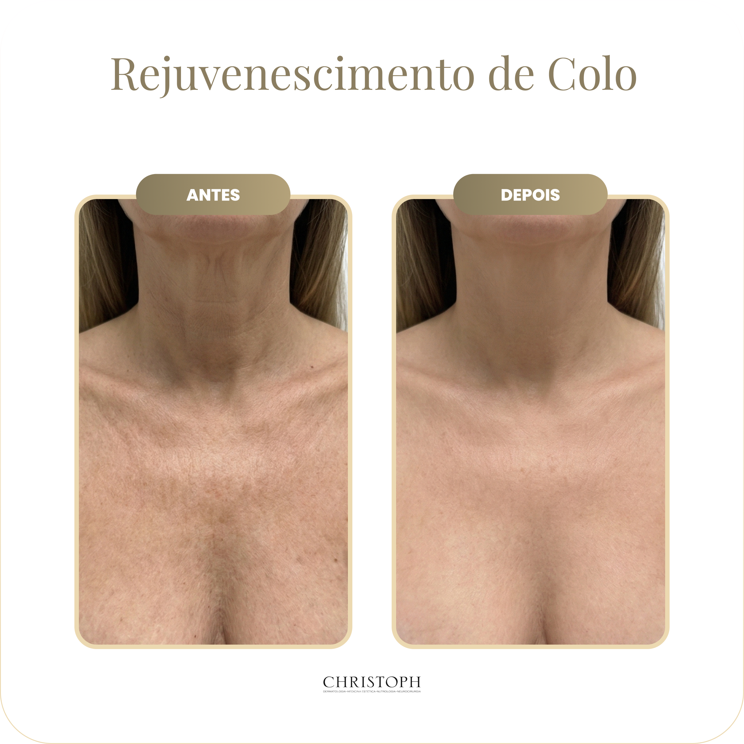rejuvenescimento_de_colo