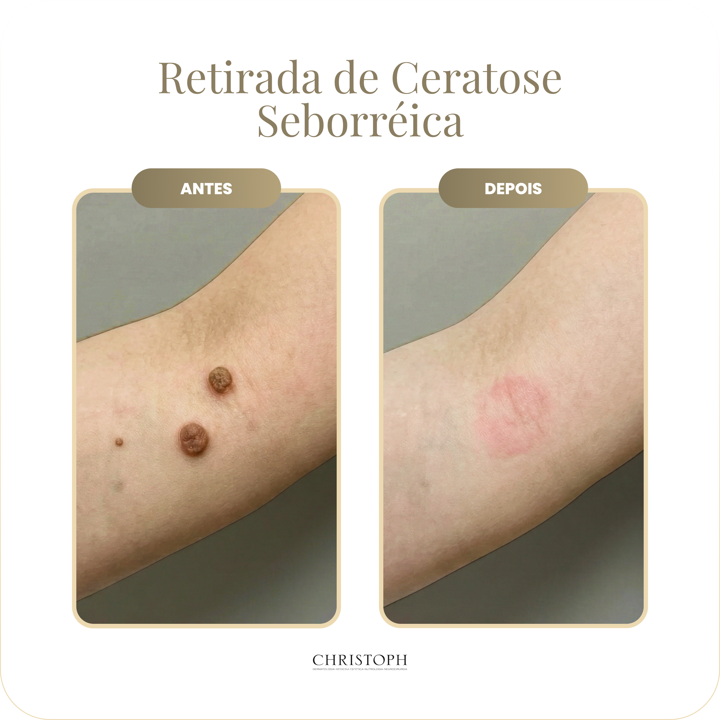 retirada_de_ceratose_seborr_ica