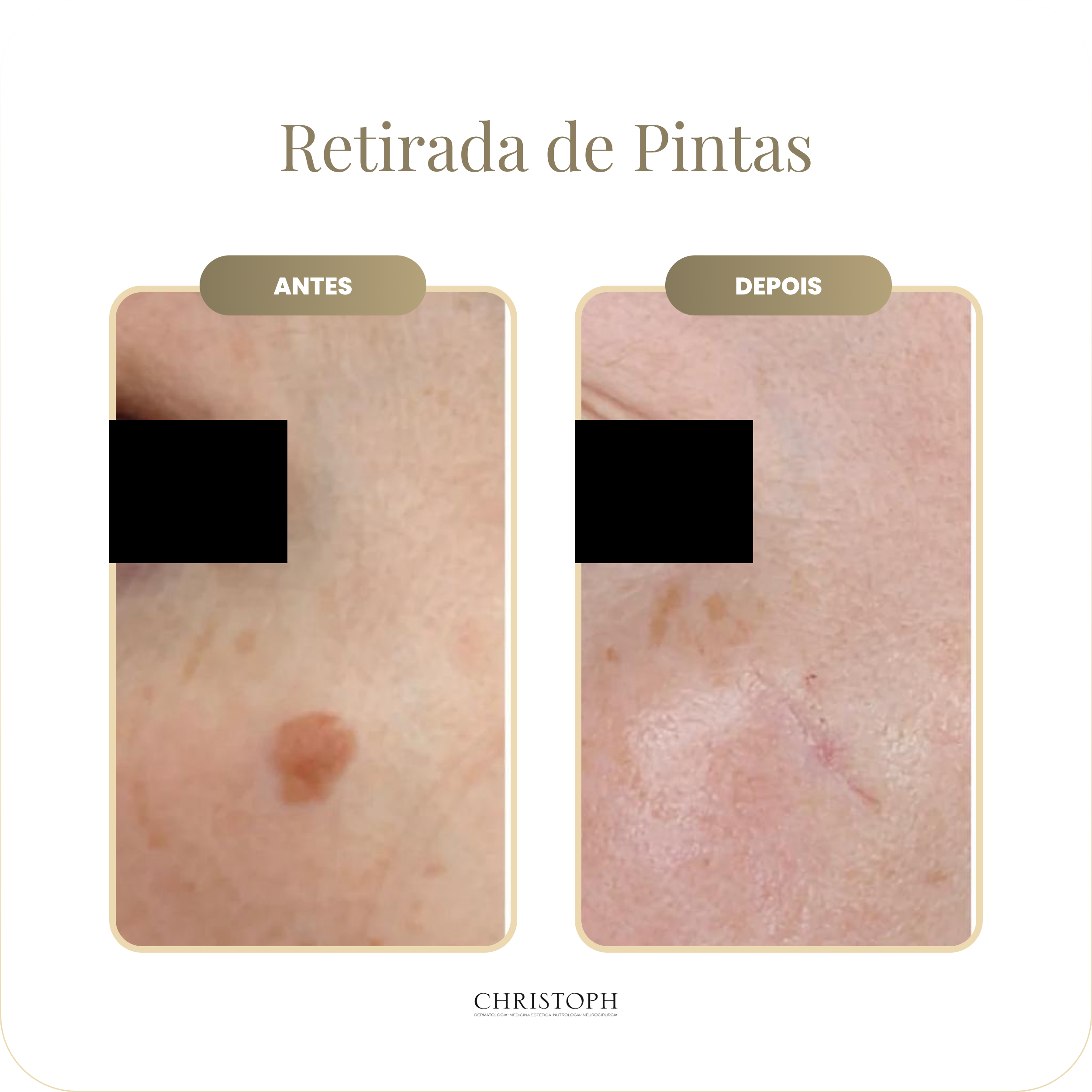 retirada_de_pintas