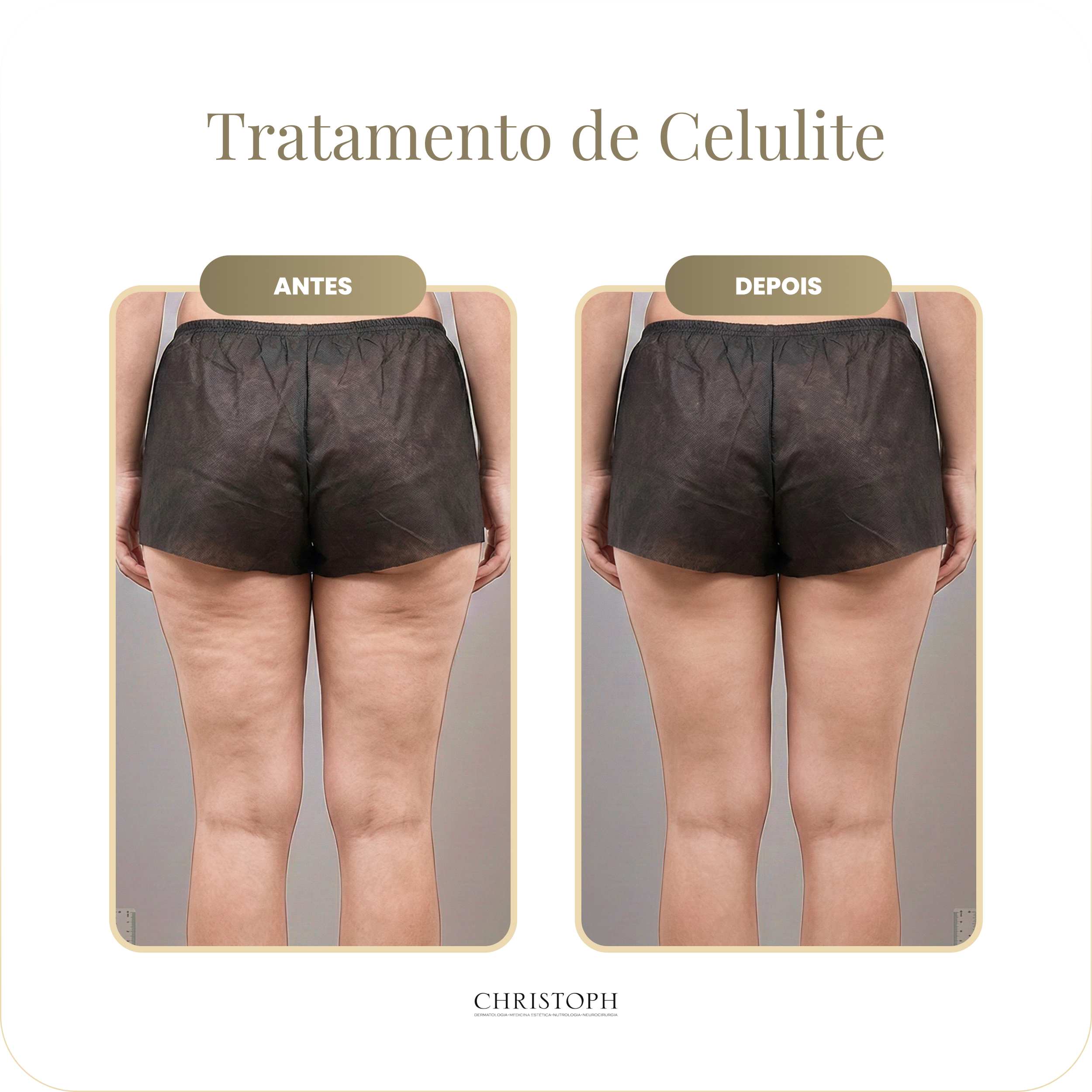 tratamento_de_celulite