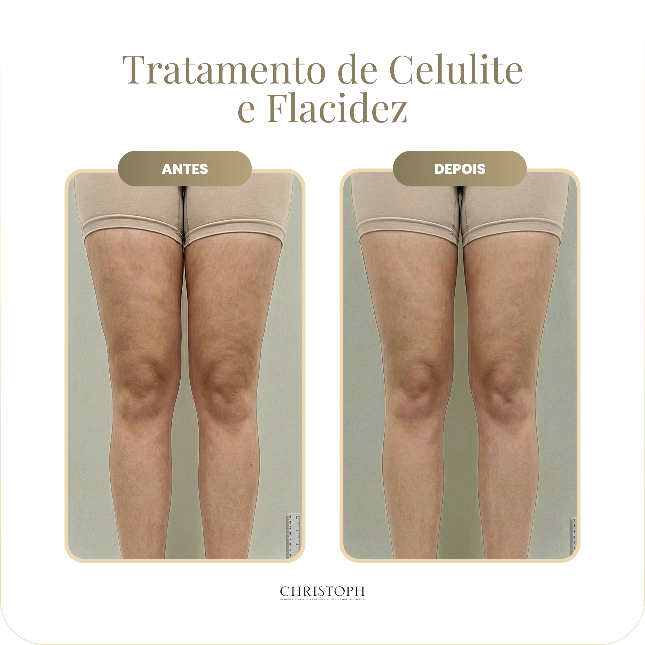 tratamento_de_celulite_e_flacidez