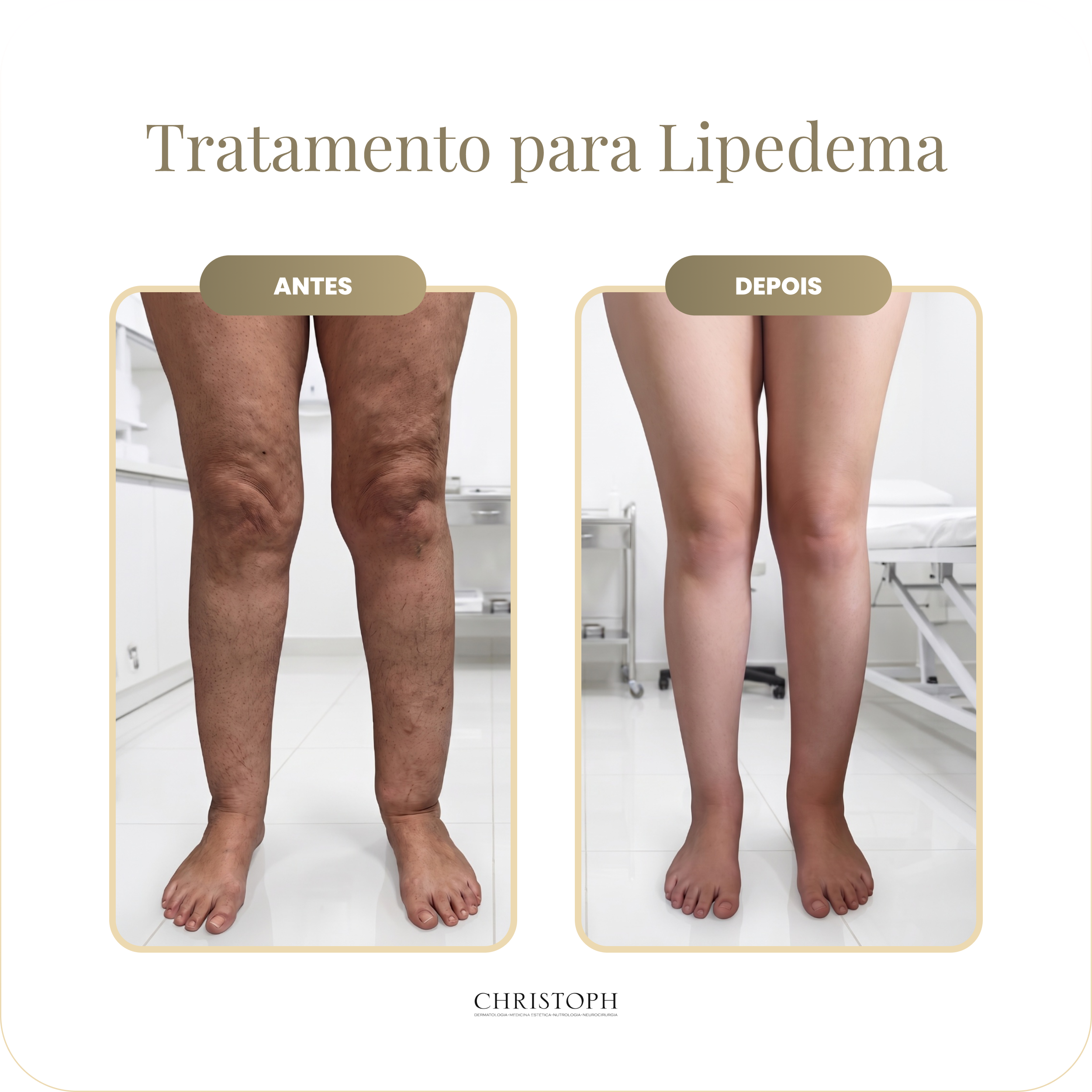 tratamento_para_lipedema
